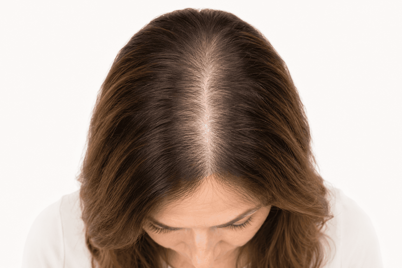 Bovenaanzicht van een vrouw met een geleidelijk bredere scheiding, een veelvoorkomend vroeg zichtbaar signaal van haarverlies bij vrouwen.