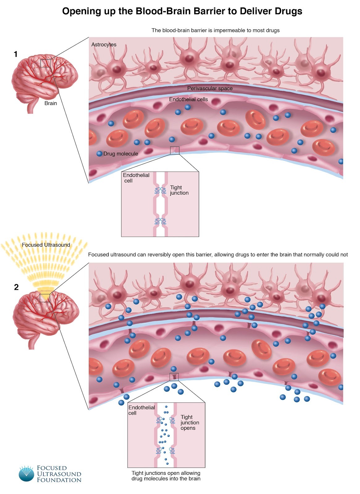 Blood-Brain Barrier Opening - Focused Ultrasound Foundation