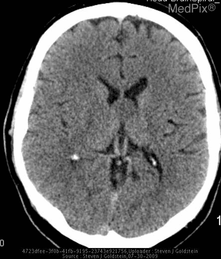 MRI image of a brain