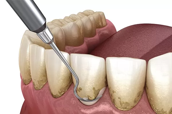 periodontal services