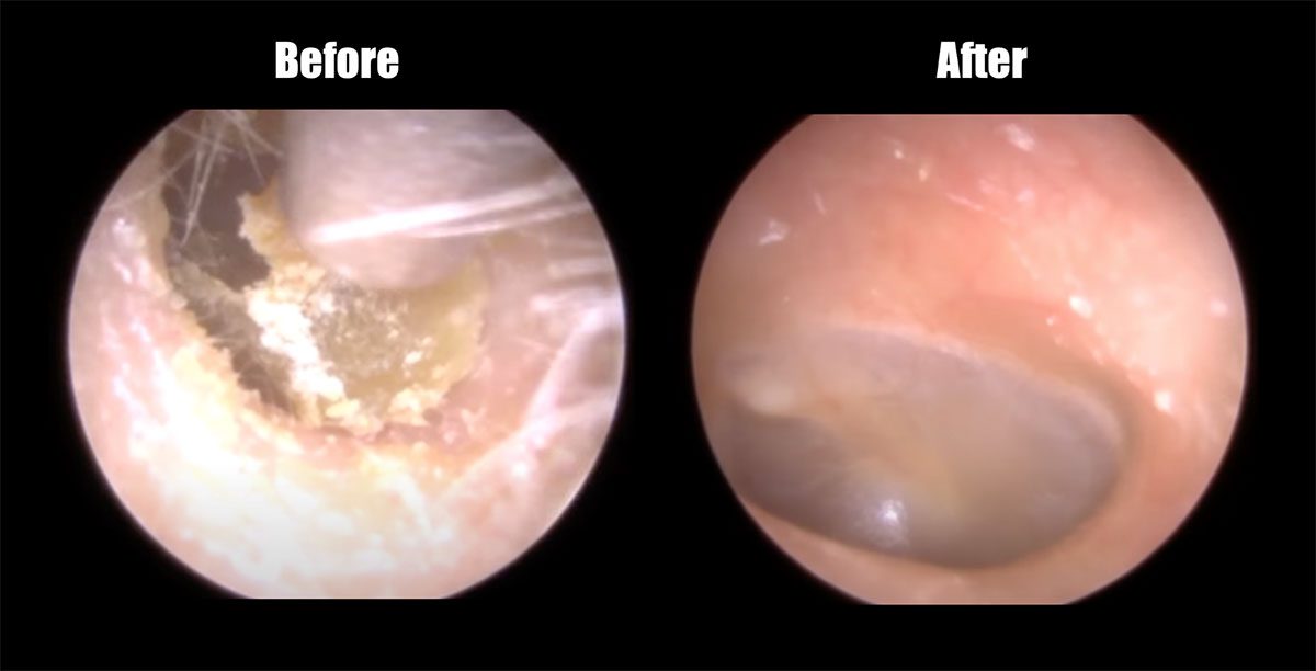 Before and after images of an ear canal, showing a buildup and subsequent removal of earwax.