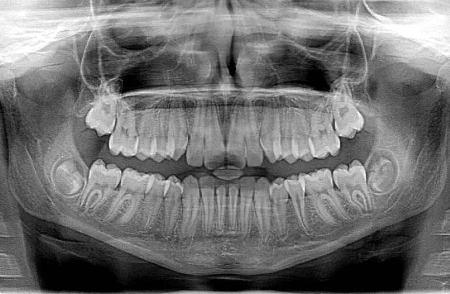 dental x-rays