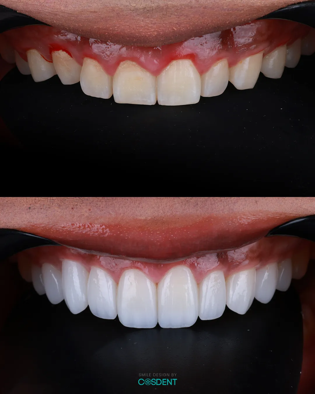 เคสวีเนียร์ก่อนและหลัง แก้ปัญหาฟันห่าง โดย COSDENT Smile Design