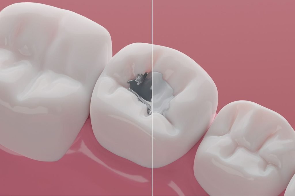 amalgam removal in Smyrna