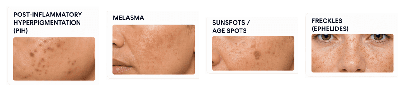 Types of hyperpigmentation.