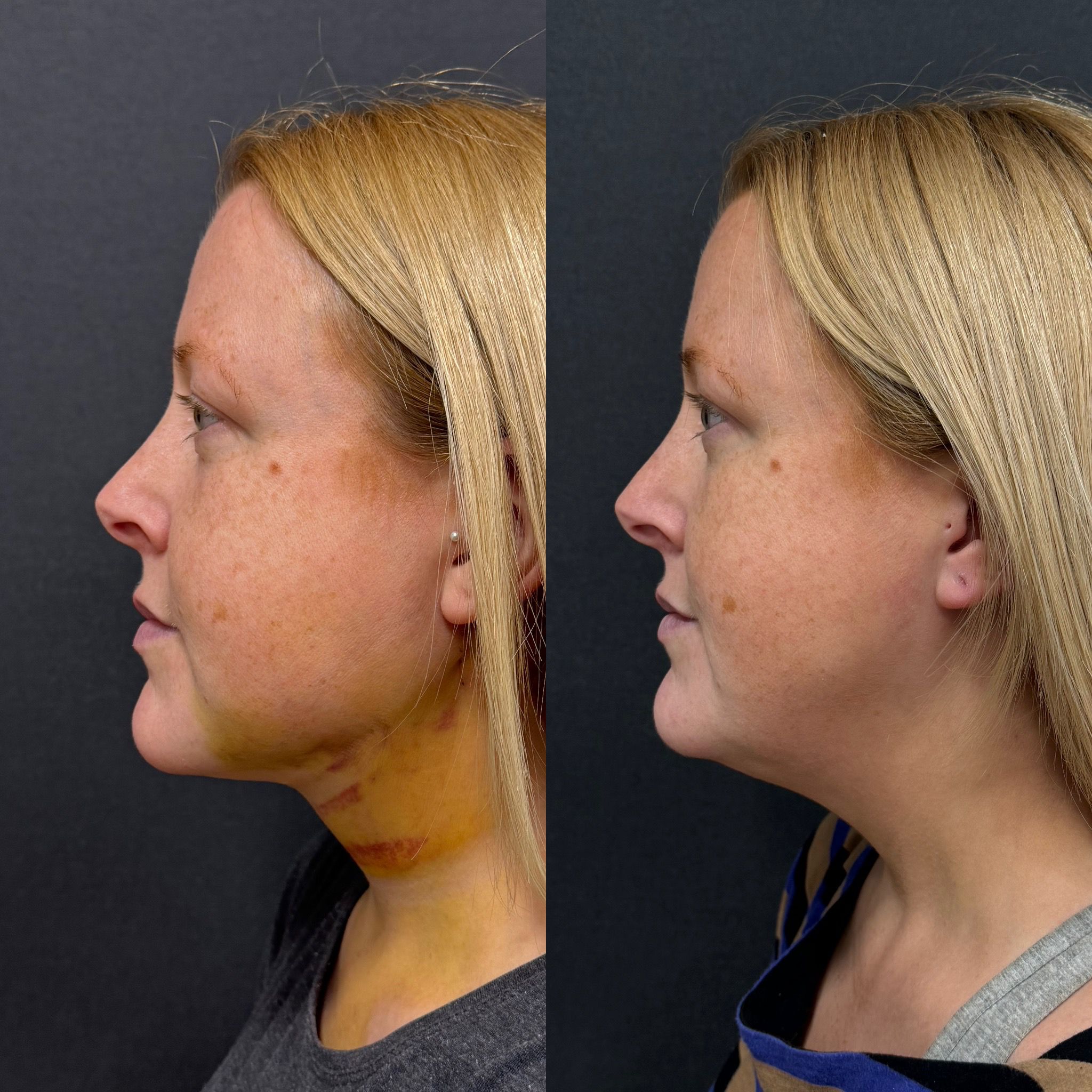 double chin laser liposuction with thread lift 1 day before after side view