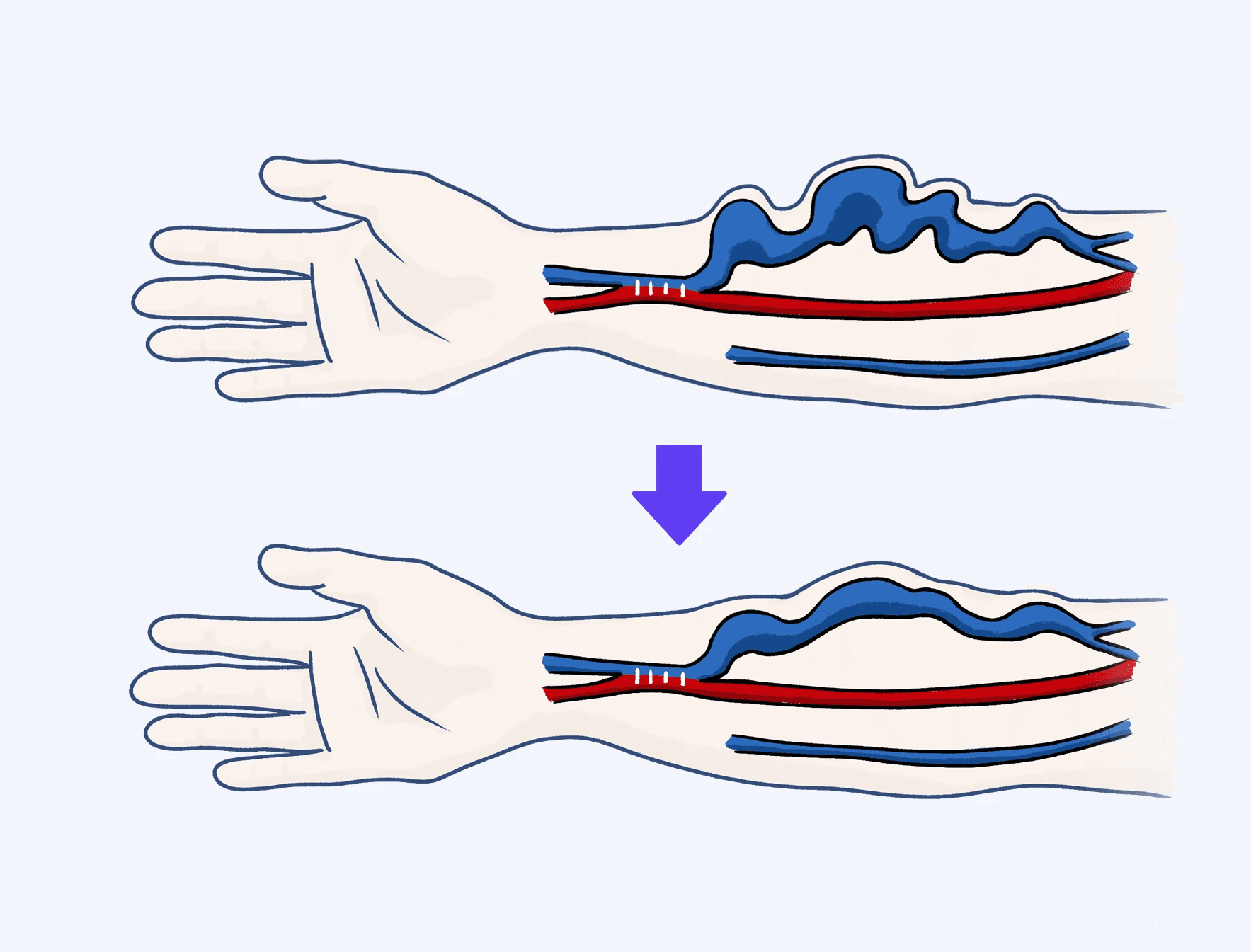 동맥류 축소술 일러스트