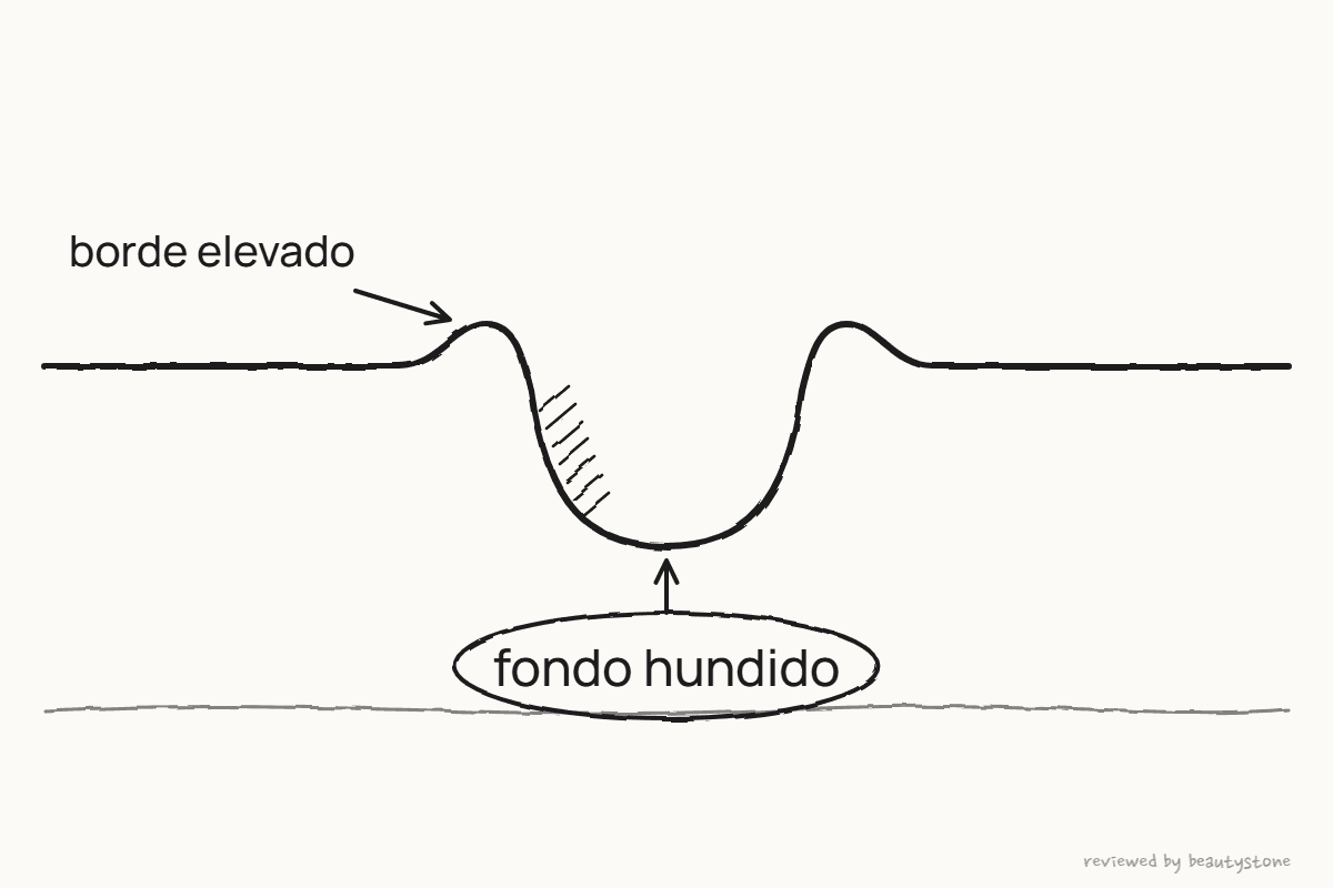Dibujo a pluma del corte de una cicatriz con el fondo hundido
