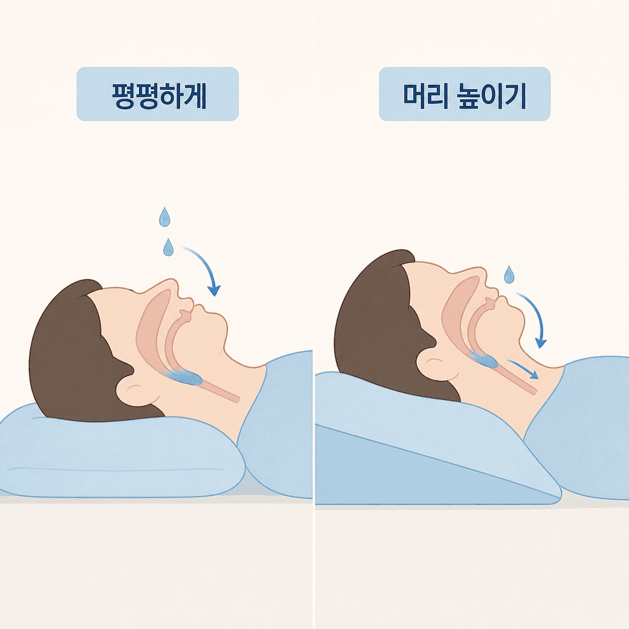 평평하게 자는 자세와 머리를 높인 자세의 체액 흐름 차이