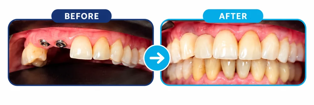 Rio Colorado Dental patient before & after