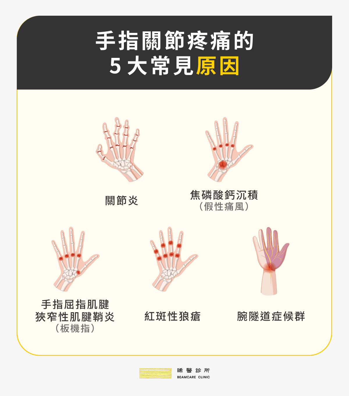 手指關節痛的 5 大常見原因