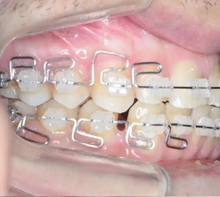 Trattamento funzionale con multi-loop edgewise archwires (MEAW) realizzati a mano 