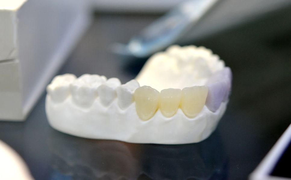 Nærbilde av en tannmodell som viser en tannbro med naturlige og erstatnings-tenner.