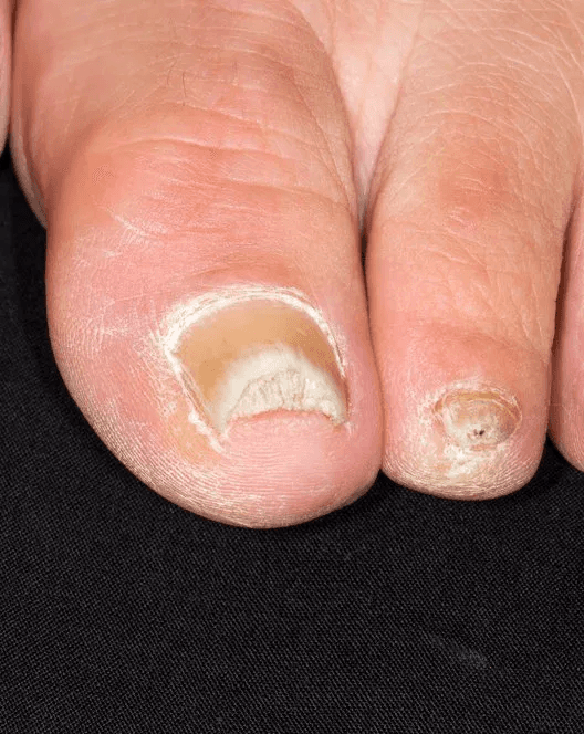 내성발톱 교정 치료를 위해 발톱 상태를 확인하는 진료 장면