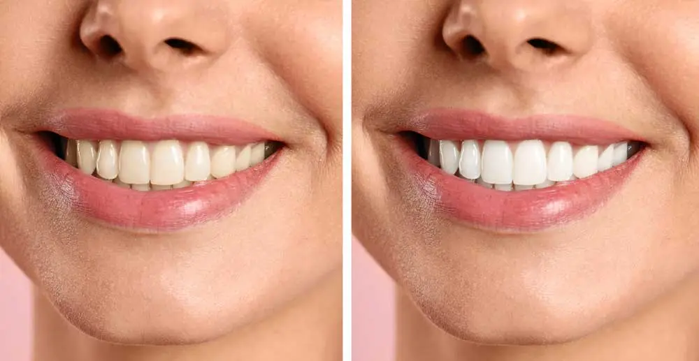 Antes e depois de um branqueamento dentário