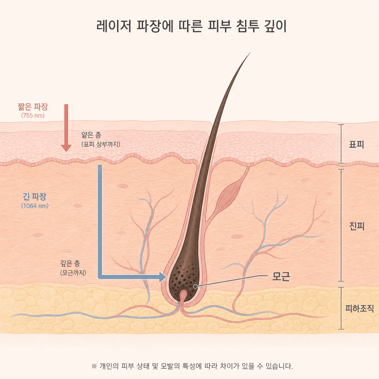 파장에 따라 흡수 깊이가 달라지는 제모 레이저의 원리