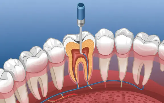 Intraoral Cameras