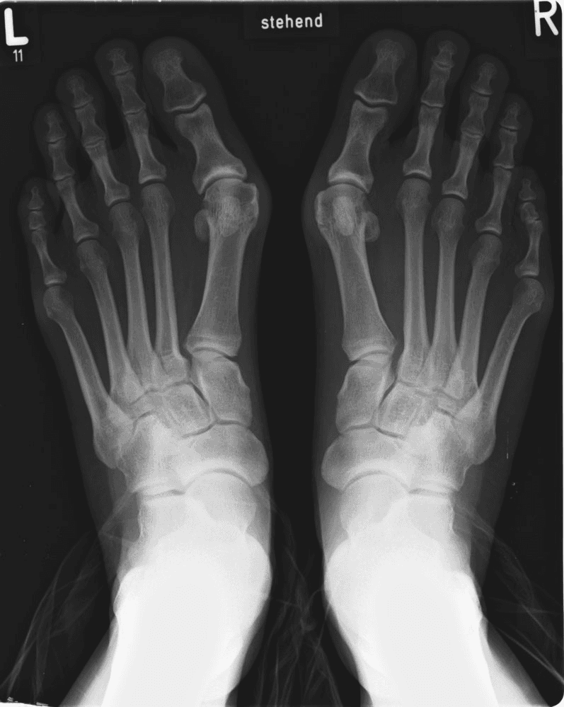 X-ray of Rare / Complex Foot Deformity