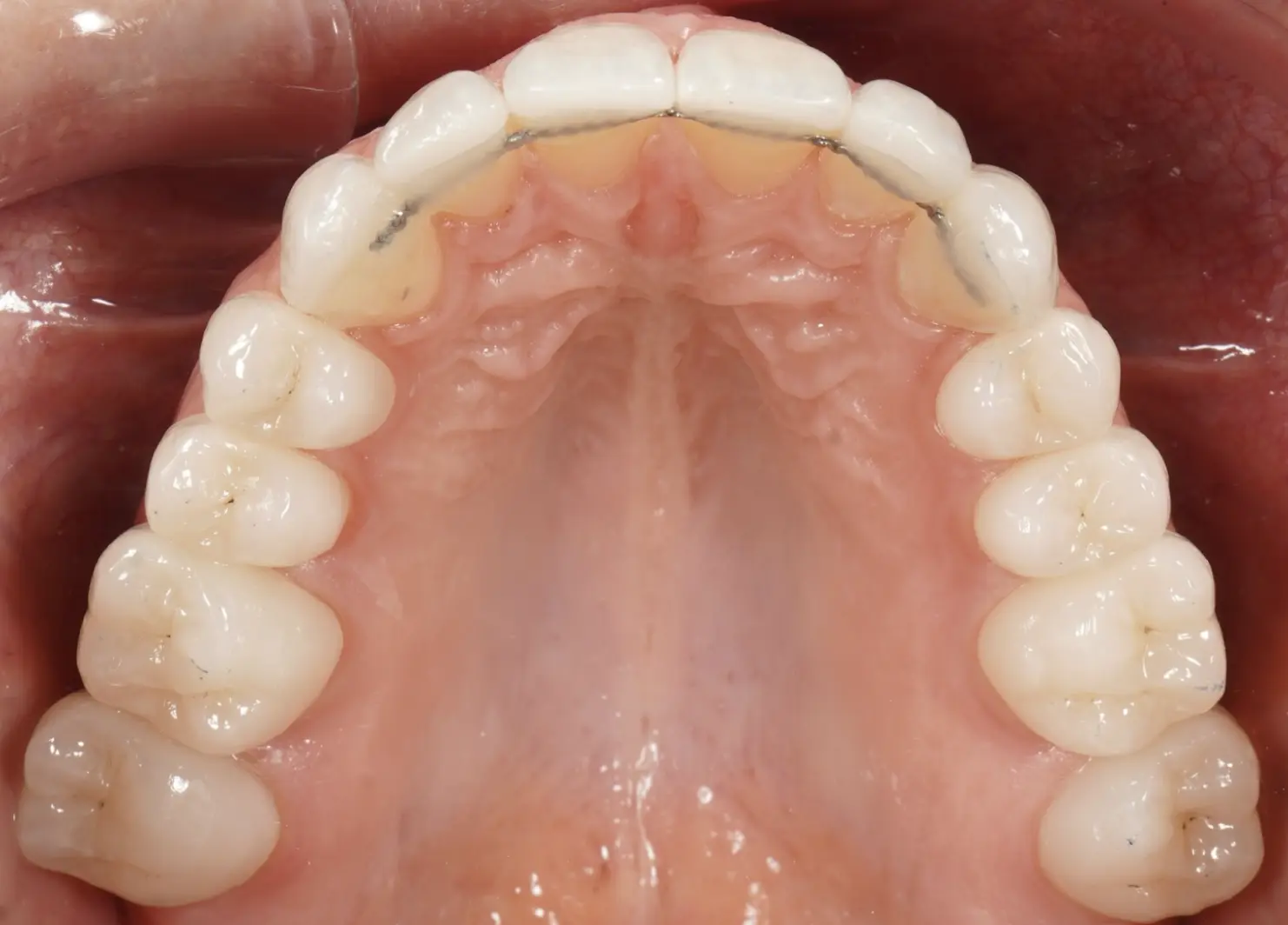 Before and after definitive ceramic restorations (crowns, veneers)
