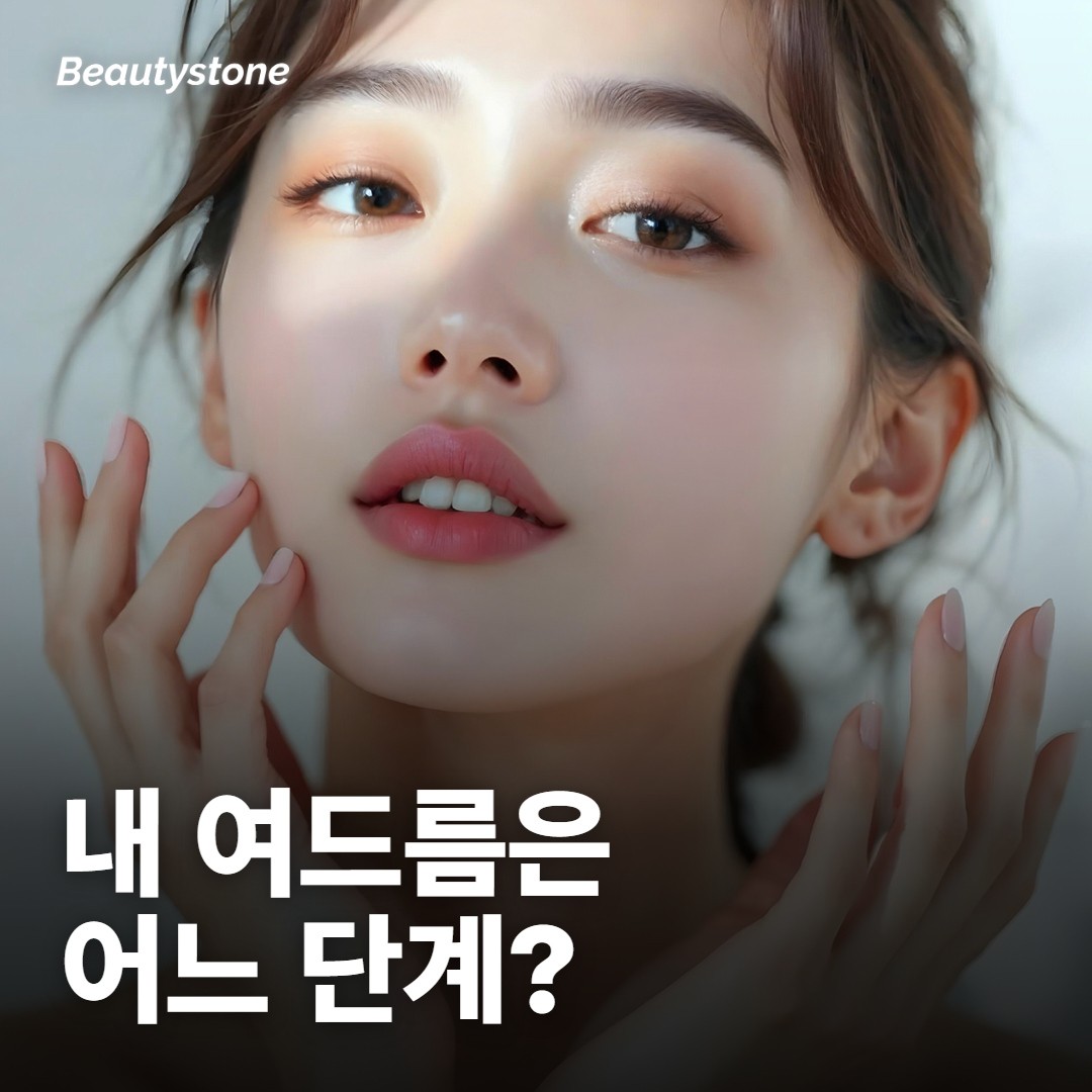 내 여드름은 면포, 염증, 결절 중 어디쯤일까요?