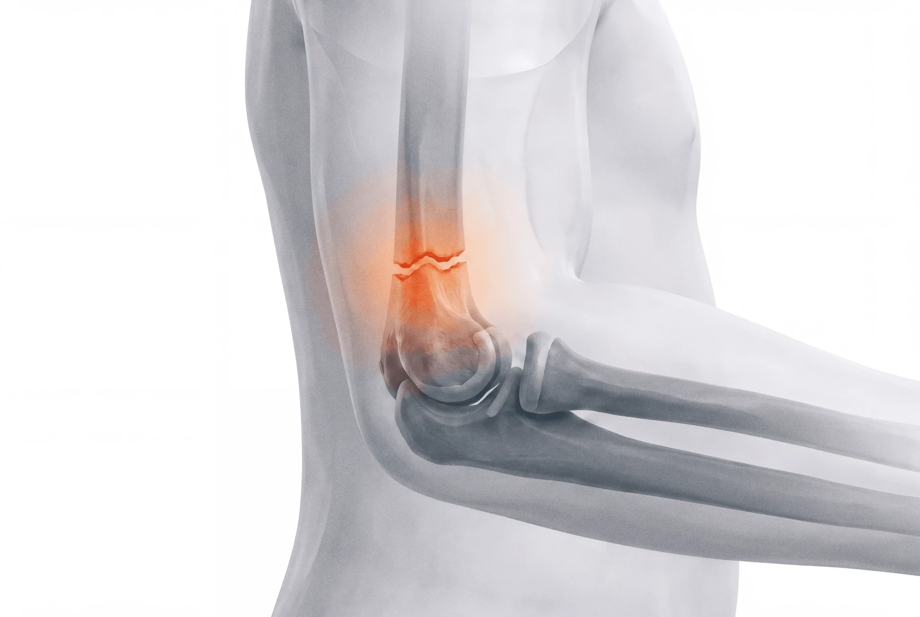 Child Supracondylar Fracture