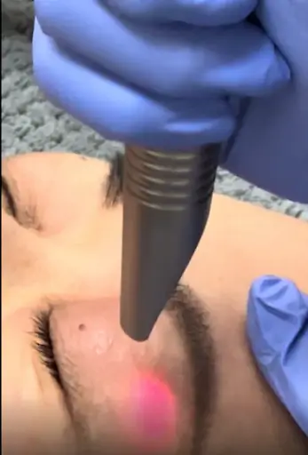 Fotona SmoothEye laser treatment applied to upper eyelid.