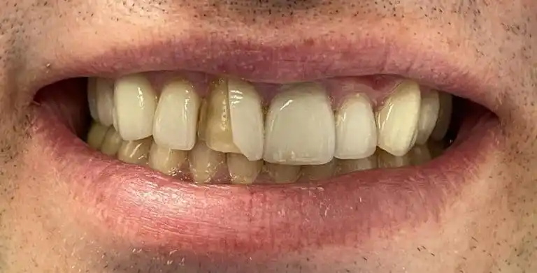 broken veneer