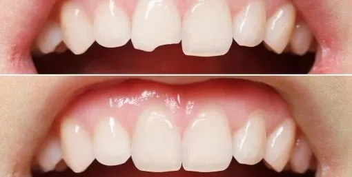 enamel shaping and contouring