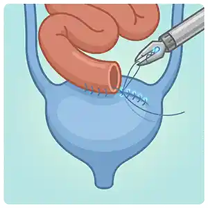 Bladder Cancer Icon Vector schematic दिखा रहा है ब्लैडर कैंसर reconstruction. एक robotic instrument सटीकता से आंत के segment को urinary tract से सिलता है, जो Intracorporeal Urinary Diversion (शरीर के अंदर पेशाब का मार्ग परिवर्तित करने की प्रक्रिया) का प्रतीक है, अंतिम ब्लैडर कैंसर treatment के लिए।