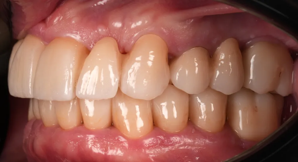 After prosthetic rehabilitation
