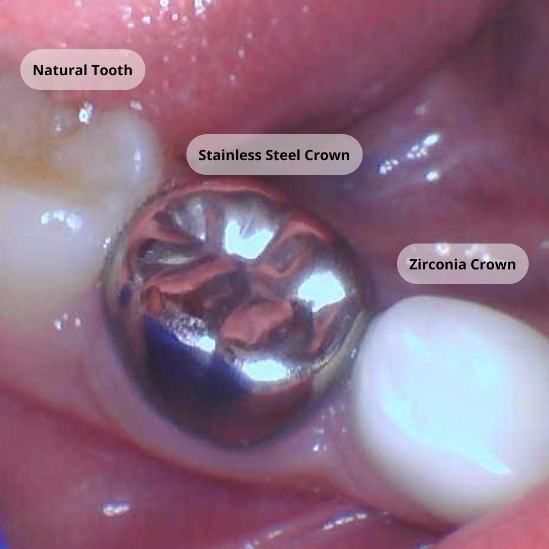 Comparison of a natural tooth next to a stainless steel crown and a white zirconia crown for children.