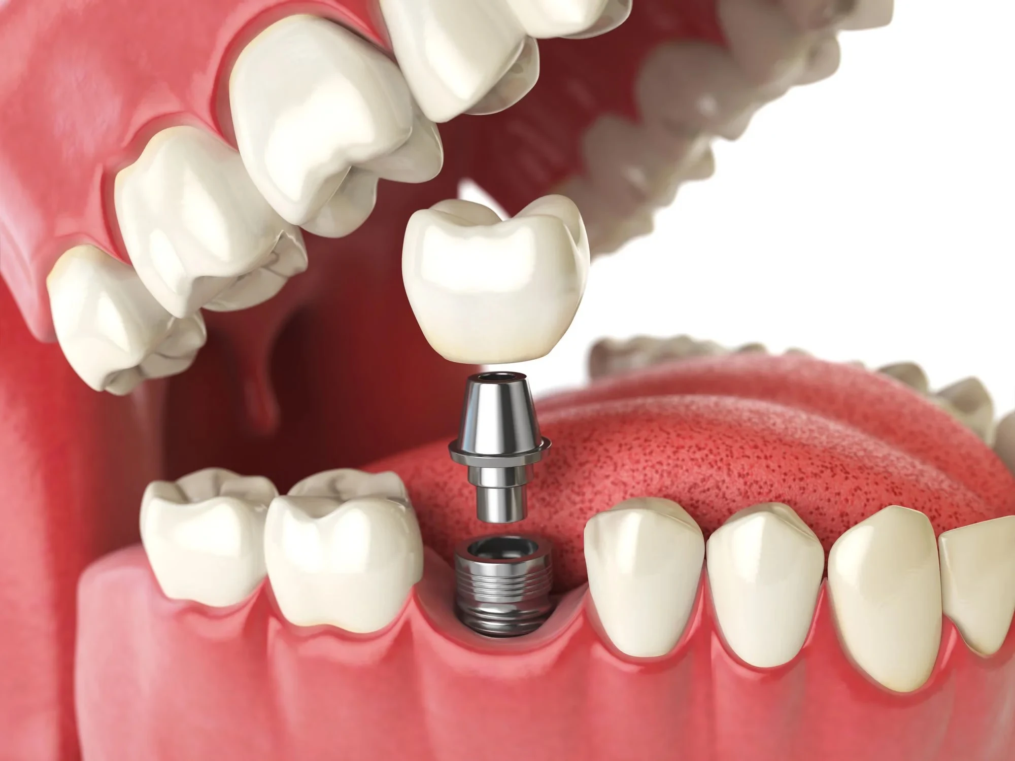 dental implants benefits