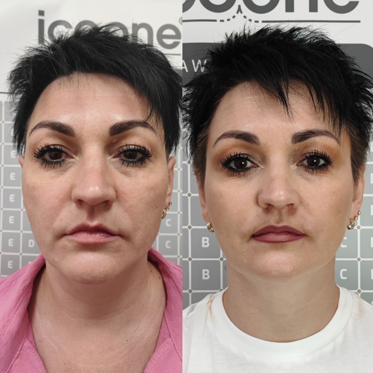 Before and after photos of laser facial rejuvenation results