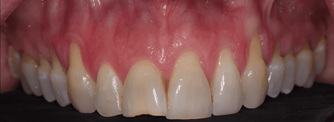 Before treatment of receding gums at Bloor-Yorkville Periodontics