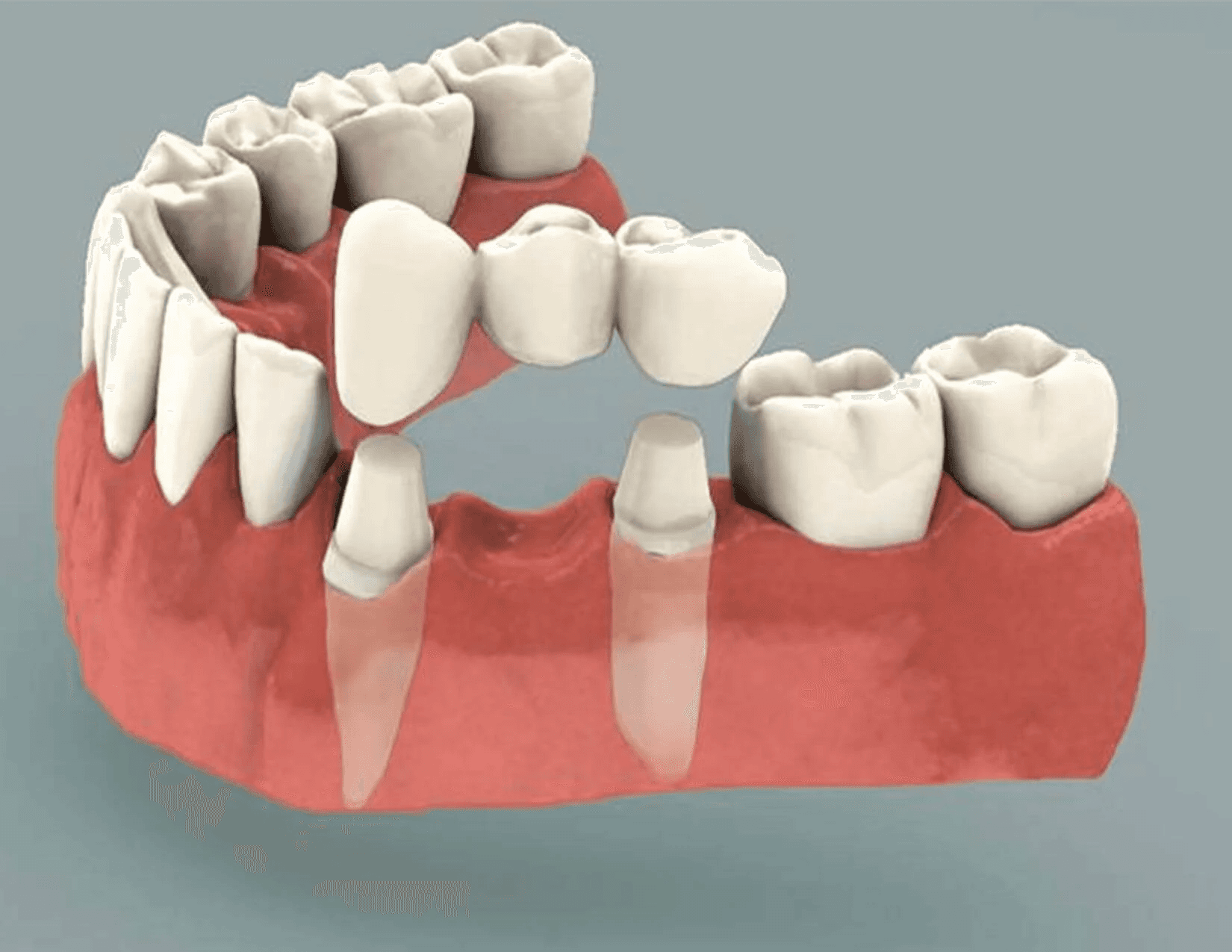 3D illustration showing a dental bridge replacing missing teeth.