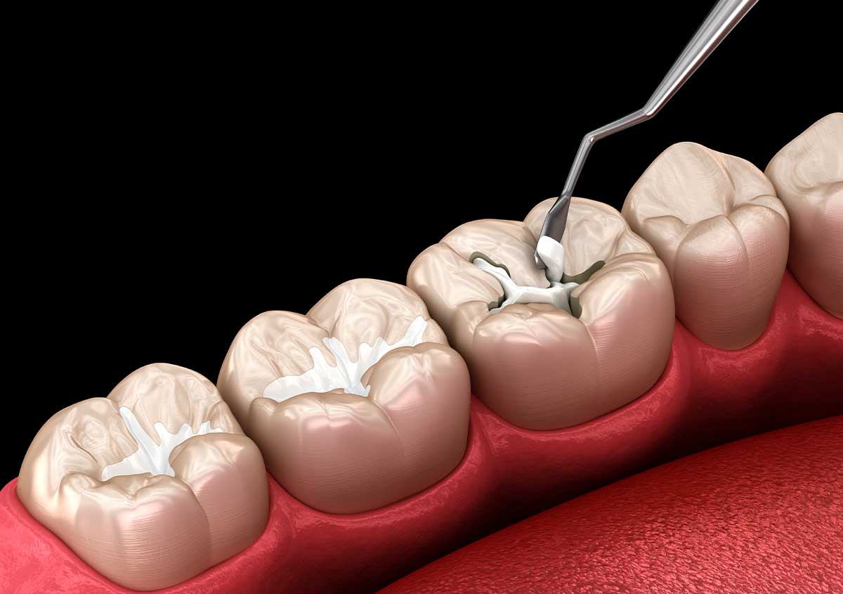 veneers