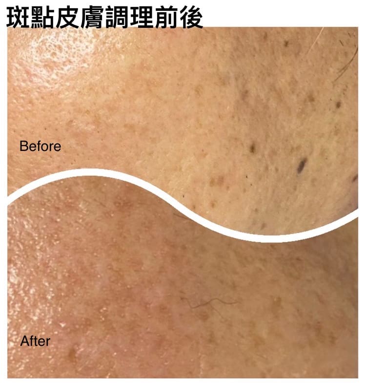 斑點皮膚調理前後