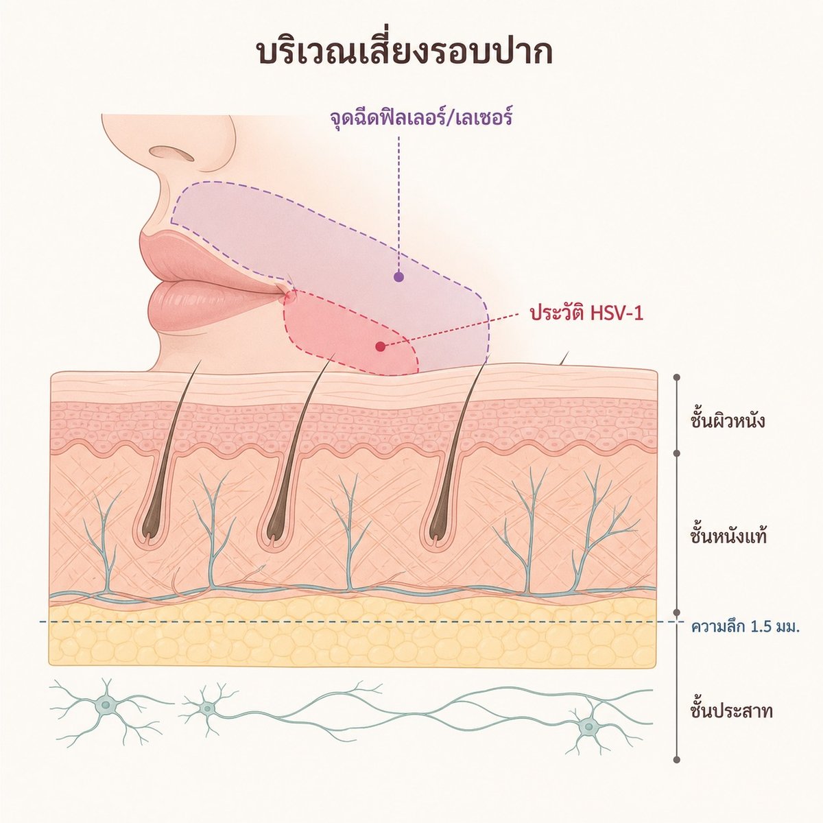 แผนภาพแสดงบริเวณเสี่ยงบนผิวหนังรอบปากสำหรับประเมินประวัติ HSV-1