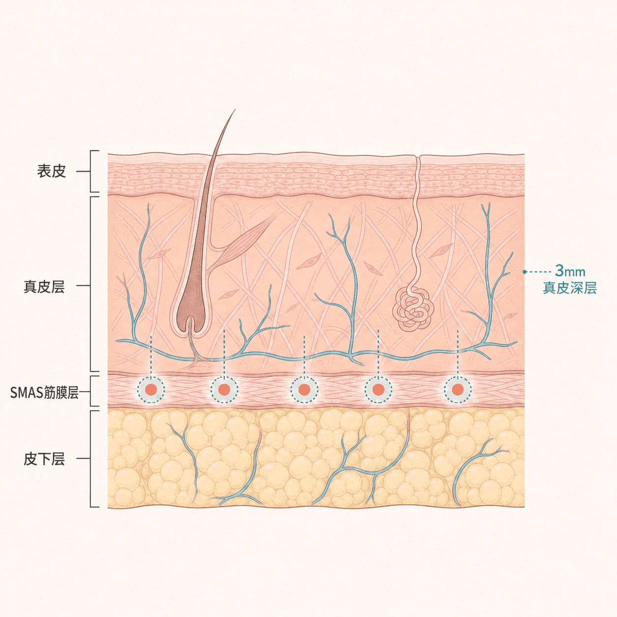 把 Ultherapy Prime 瞄准的皮肤深层简化后的示意图。