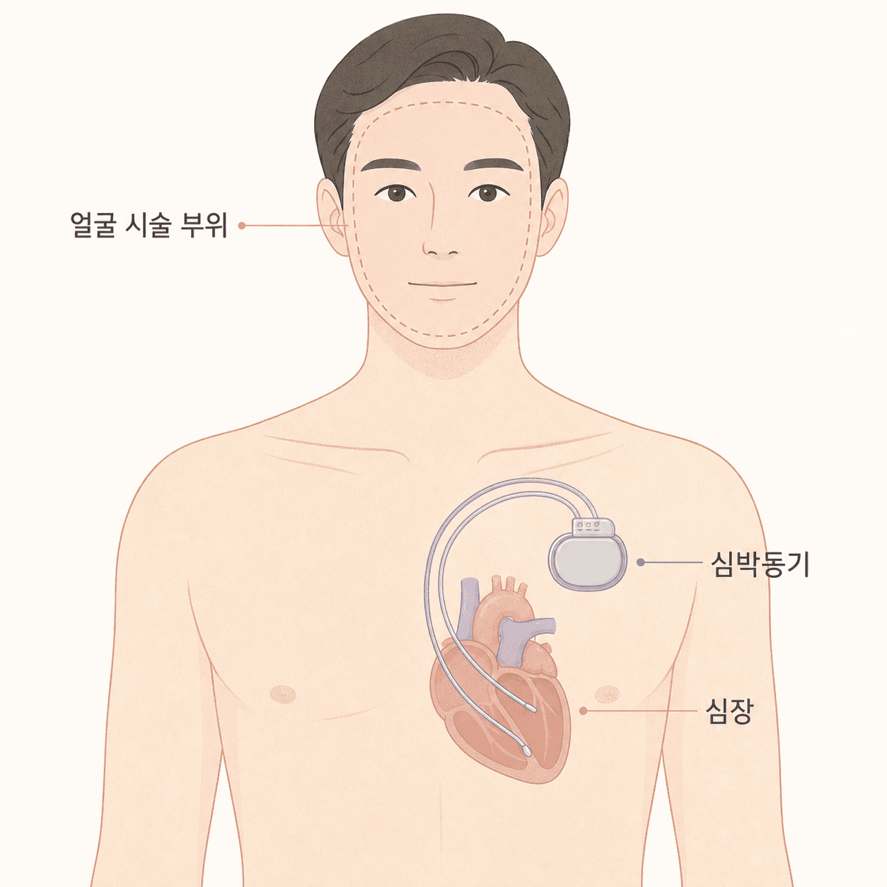 얼굴 시술 부위와 가슴 심박동기의 위치 관계
