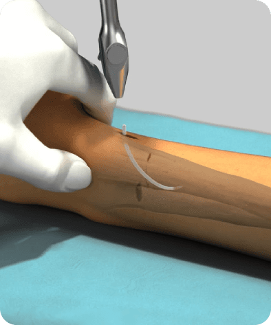 Felszívódó implantátum 3 dimenziós illusztrációja. A törött csontba helyezett vékony implantátum.
