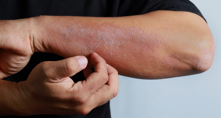 prevención de dermatitis atópica en Farmacia Mutilva