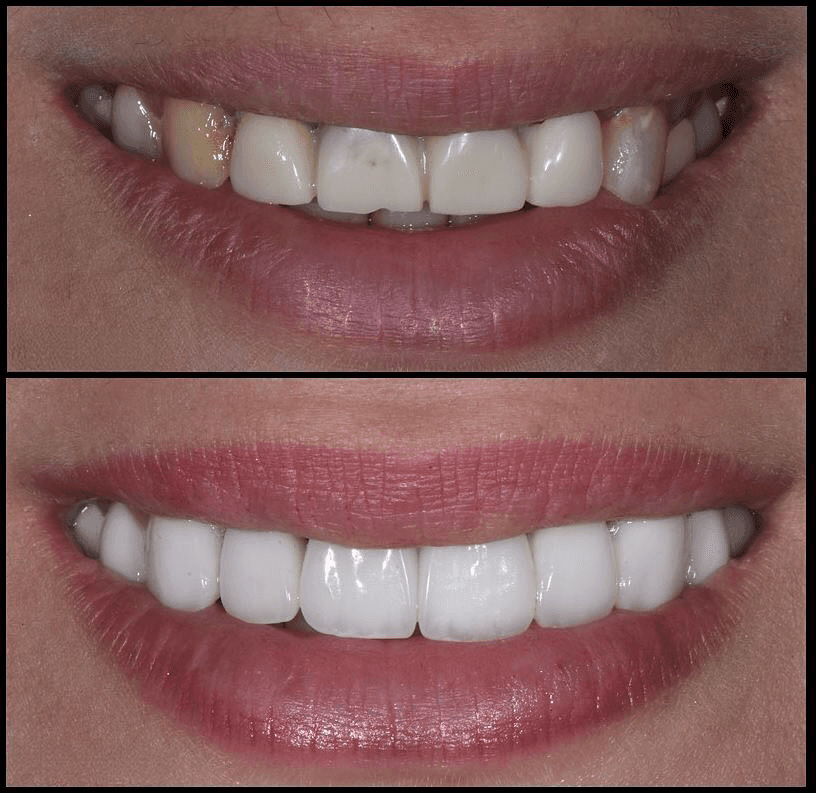 A perfect smile makeover with dental veneers in Dubai, showing before-and-after images of straighter teeth and whiter enamel.