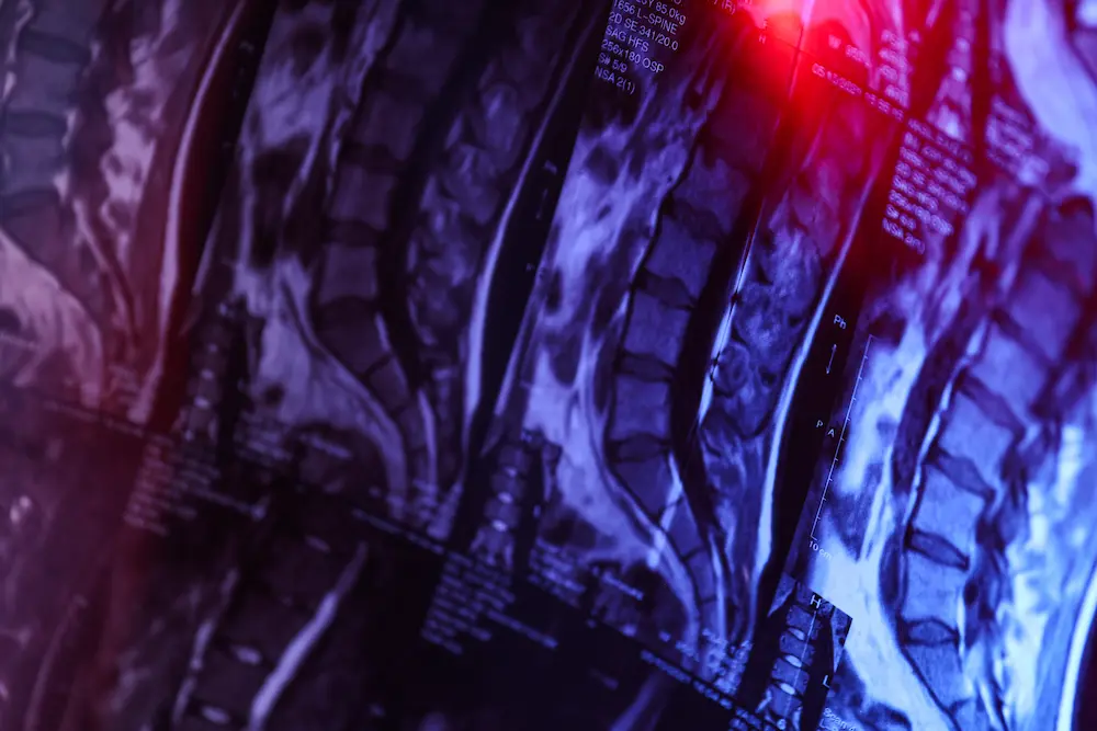 xray of spinal cord injury