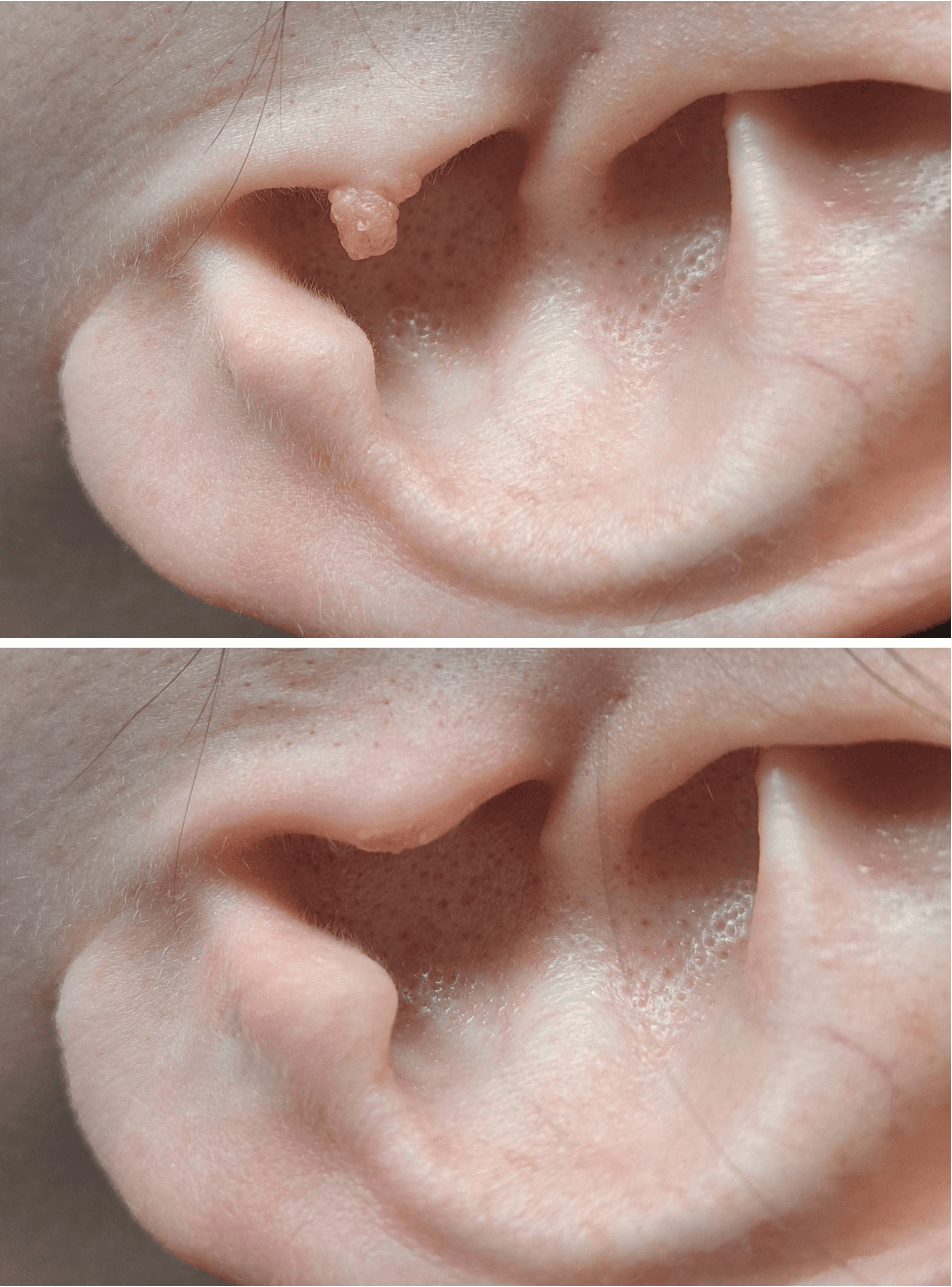 Skin tag lam probe removal