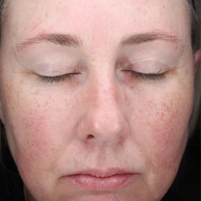 After soothing anti-inflammatory treatment at The Vancouver Aesthetician — rosacea and redness visibly calmed and skin tone noticeably more even