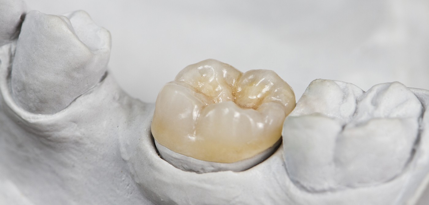 Dental Crowns