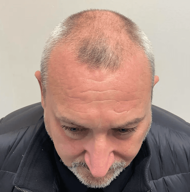 Before hair transplant – Peter's FUE Hair Transplant