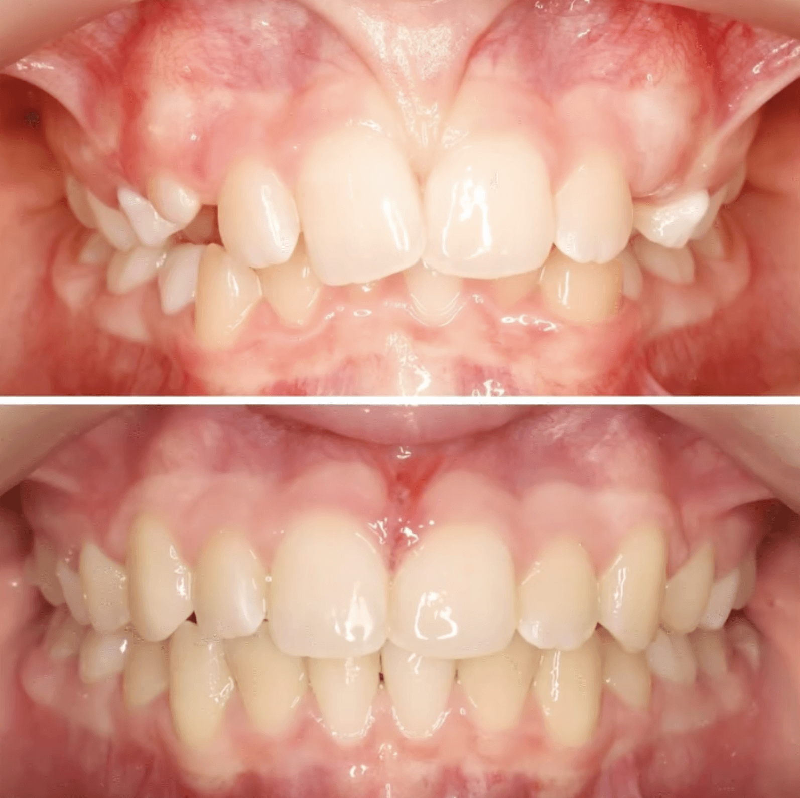 Invisalign before and after of teeth showing severe overbite correction and improved bite alignment at Invisalign Center in Dubai