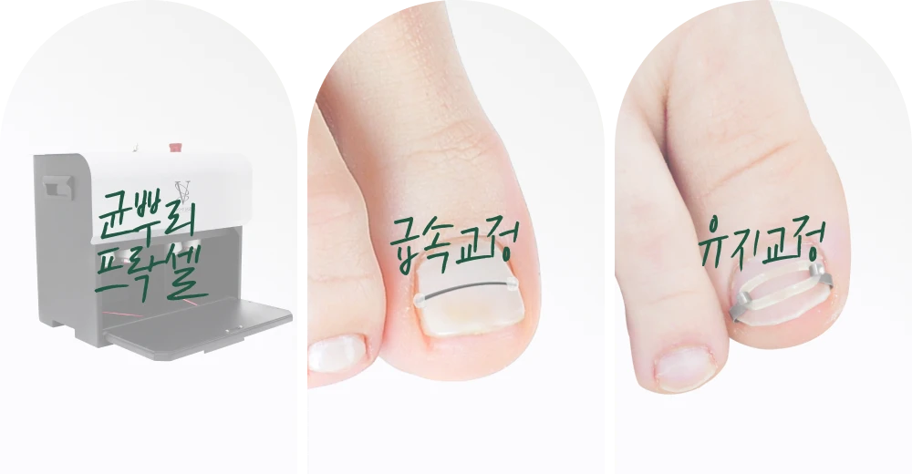 족부_시그니처프로그램_대표이미지_르샤인